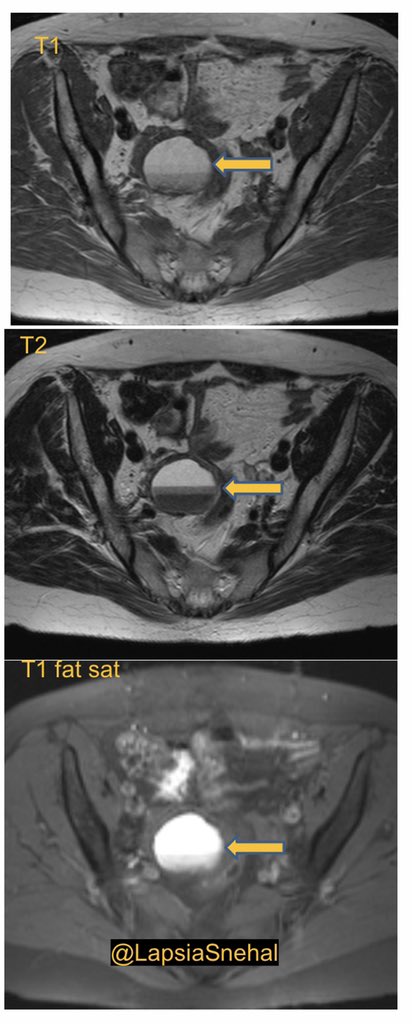 LapsiaSnehal's tweet photo. Female patient with fluid fluid levels within an Endometrioma secondary to repeated haemorrhage. #FOAMed #FOAMrad #MedStudentTwitter #obygyn #radres #futureradres https://t.co/sLFv1g30N2