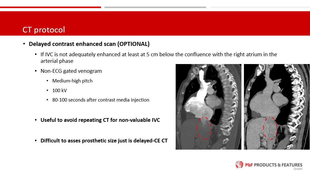 Tips&Tricks in how to perform and assess a CT scan for #TricValve pre-procedural planning