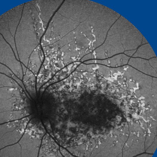 "Recurrent, Self-inflicted Laser Retinal Injury”

Fundus autofluorescence highlights confluent laser scars w/ vertical streaks caused by bell’s phenomenon during continuous laser exposure.

📸:Joseph Simonett, MD, Akbar Shakoor, MD &amp; Danielle Wiscomb, <a href="/HeidelbergEngUK/">Heidelberg Engineering Ltd.</a> Spectralis