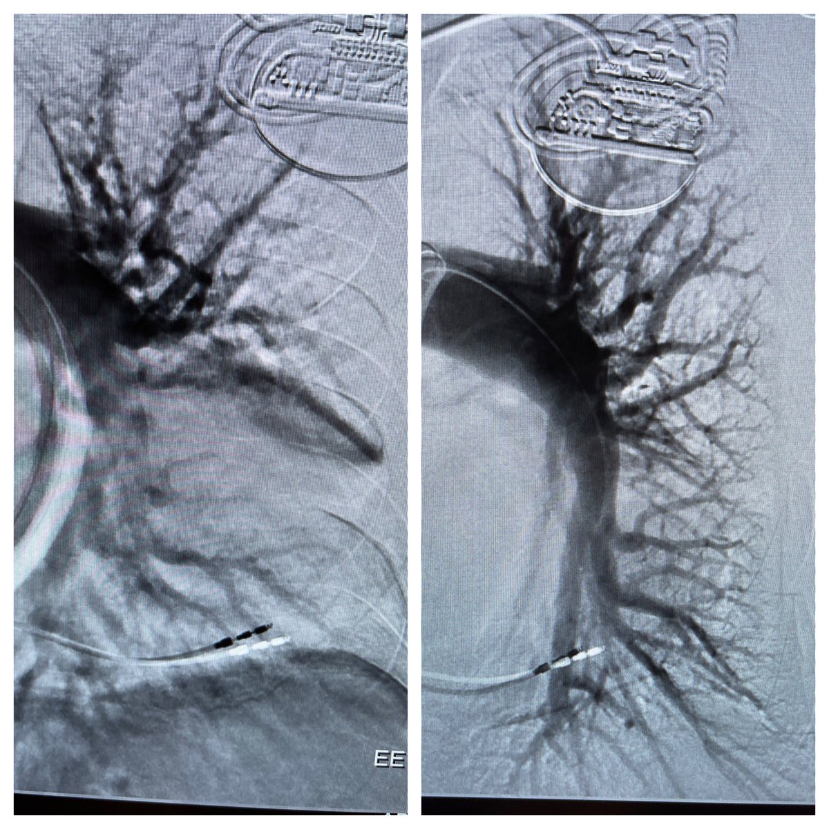 markiewicz_md's tweet photo. 70 yo 15 L venti mask sat 85%with presyncope bilateral pe .live broadcast with recording for teaching file by @AvailMedsystems .Perfect teaching case. T24 #bloodlessthrombectomy @inari. Left no oxygen. @KeenaMetcalf @chrisjtyler @tague_kara @jcgeorgemd @MichaelJolly77 https://t.co/Hc3r0StZok