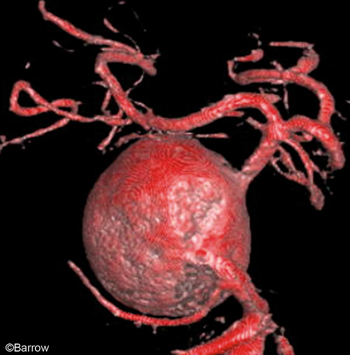 On the final day of #AneurysmAwarenessMonth, we're bringing you our seventh and final aneurysm image selected by Barrow President and CEO <a href="/mtlawton/">Michael T. Lawton, MD</a>, MD, and #Neuroscience Publications Manager Mark Schornak.