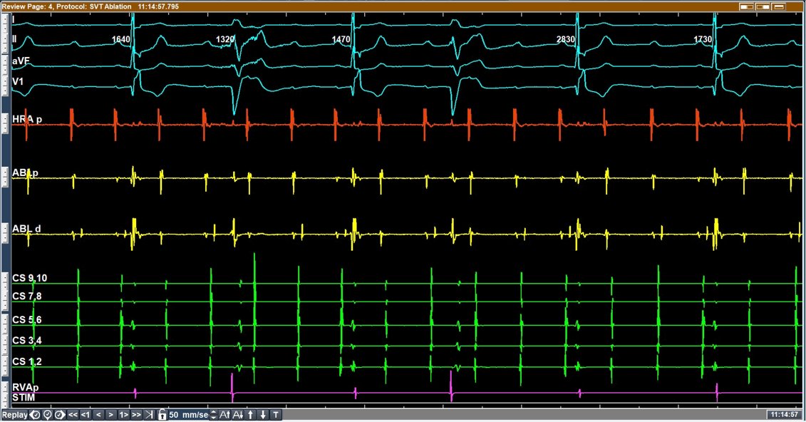 Syamkumar (@syamkumarmd) on Twitter photo At times, it is way easier to treat the problem than "defining " it😀. A tracing for EP fellows ponder about #EPeeps . What is the pattern of conduction here? <a href="/EPeeps_Bot/">EP_Bot</a> <a href="/CHRS_SCR/">Canadian Heart Rhythm Society</a> <a href="/Yorgo_V/">Yorgo Veenhuyzen</a> <a href="/adribaran/">Adrian Baranchuk MD FACC FRCPC FCCS FSIAC</a> <a href="/NimaZamiri/">Nima Zamiri</a> <a href="/bishoydf/">Bishoy Deif</a> <a href="/UlhasDr/">Dr Ulhas Pandurangi</a> <a href="/ELabartkava/">Eugene Labartkava</a> <a href="/MartowMartow/">Evan Martow</a> <a href="/SergioPinski/">Sergio Pinski</a> At times, it is way easier to treat the problem than "defining " it😀. A tracing for EP fellows ponder about #EPeeps . What is the pattern of conduction here? <a href="/EPeeps_Bot/">EP_Bot</a> <a href="/CHRS_SCR/">Canadian Heart Rhythm Society</a> <a href="/Yorgo_V/">Yorgo Veenhuyzen</a> <a href="/adribaran/">Adrian Baranchuk MD FACC FRCPC FCCS FSIAC</a> <a href="/NimaZamiri/">Nima Zamiri</a> <a href="/bishoydf/">Bishoy Deif</a> <a href="/UlhasDr/">Dr Ulhas Pandurangi</a> <a href="/ELabartkava/">Eugene Labartkava</a> <a href="/MartowMartow/">Evan Martow</a> <a href="/SergioPinski/">Sergio Pinski</a>