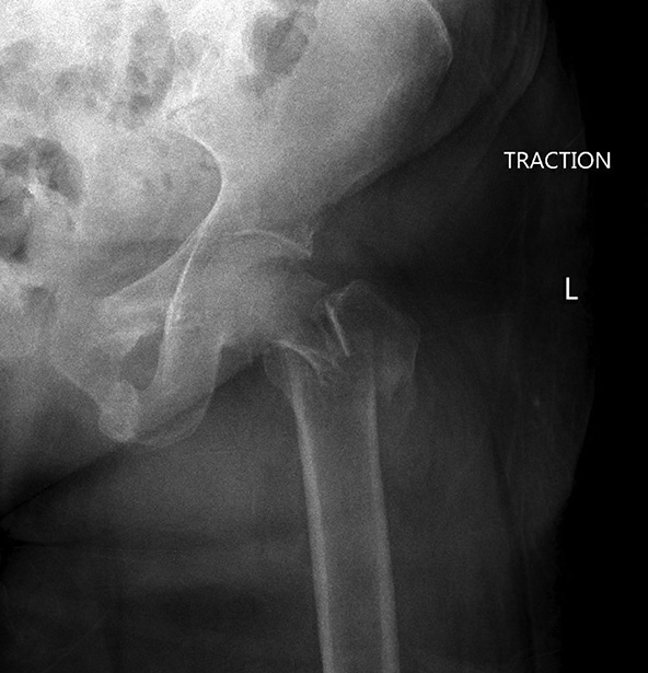 Periarticular #Hip and #Knee Fractures: Fix or Replace? Dr. Cynthia Emory mines pros, cons, and pearls from <a href="/JosephHsuMD/">Joseph R. Hsu, MD</a> and <a href="/yoon_rs/">Richard S. Yoon, MD</a> in #AAOSNow. Evergreen tip from Dr. Yoon: “Find what you’re comfortable with and know what your limitations are.” bit.ly/3mgcGTs