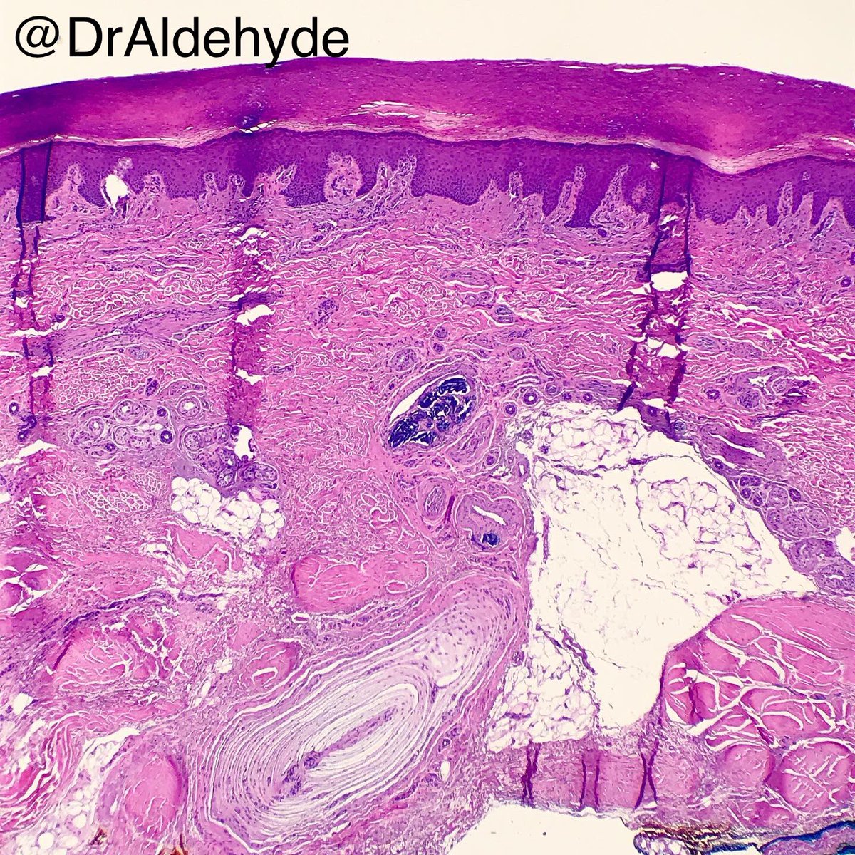 DrAldehyde's tweet photo. #DermPath fellowship #MatchDay special. 😆🔬
Good luck to all those applicants and programs out there tomorrow!
Life is full of expected AND unexpected surprises like this. Incidental findings always make my daily work more interesting.
#pathology #PathNerds https://t.co/fbo1VRtuo9