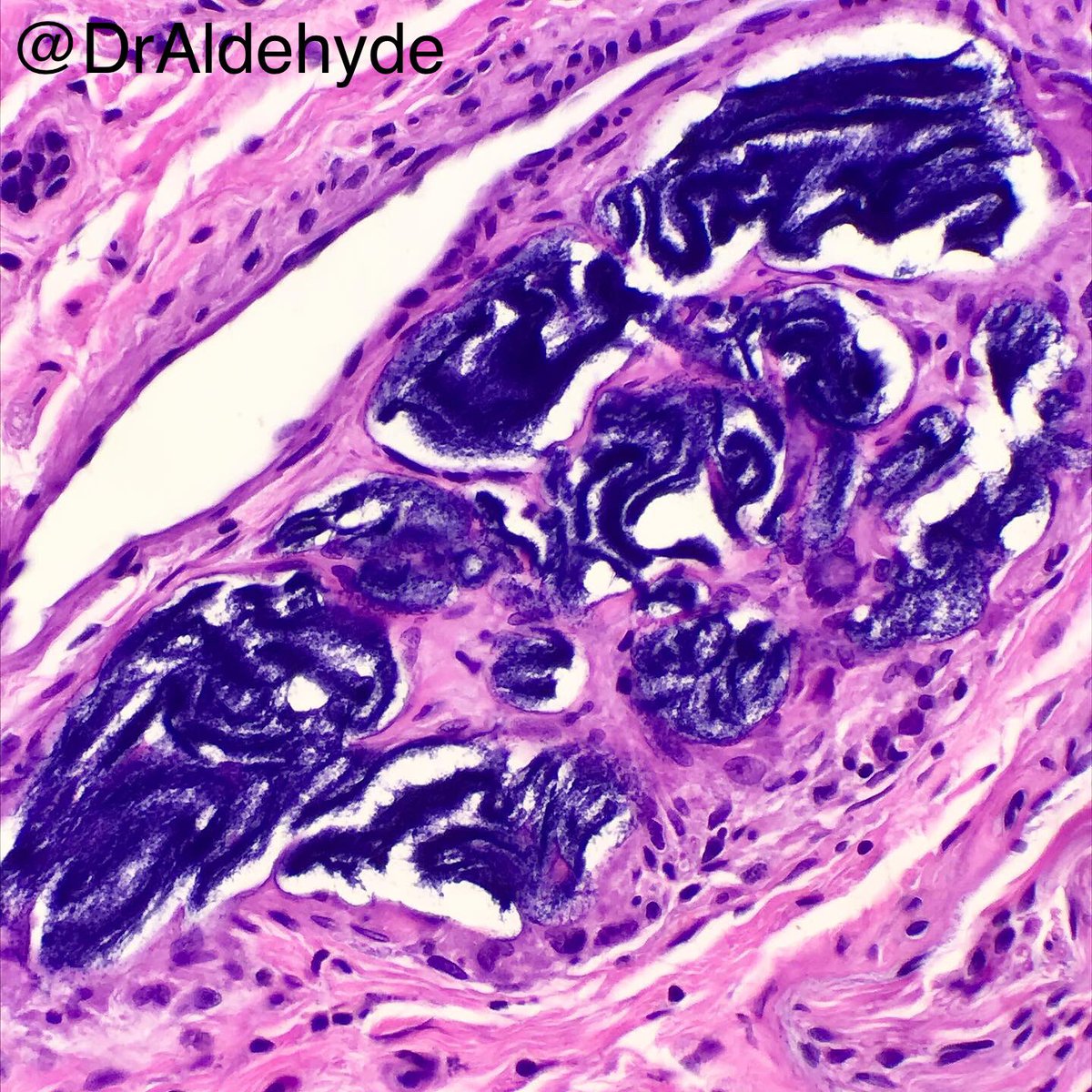 DrAldehyde's tweet photo. #DermPath fellowship #MatchDay special. 😆🔬
Good luck to all those applicants and programs out there tomorrow!
Life is full of expected AND unexpected surprises like this. Incidental findings always make my daily work more interesting.
#pathology #PathNerds https://t.co/fbo1VRtuo9