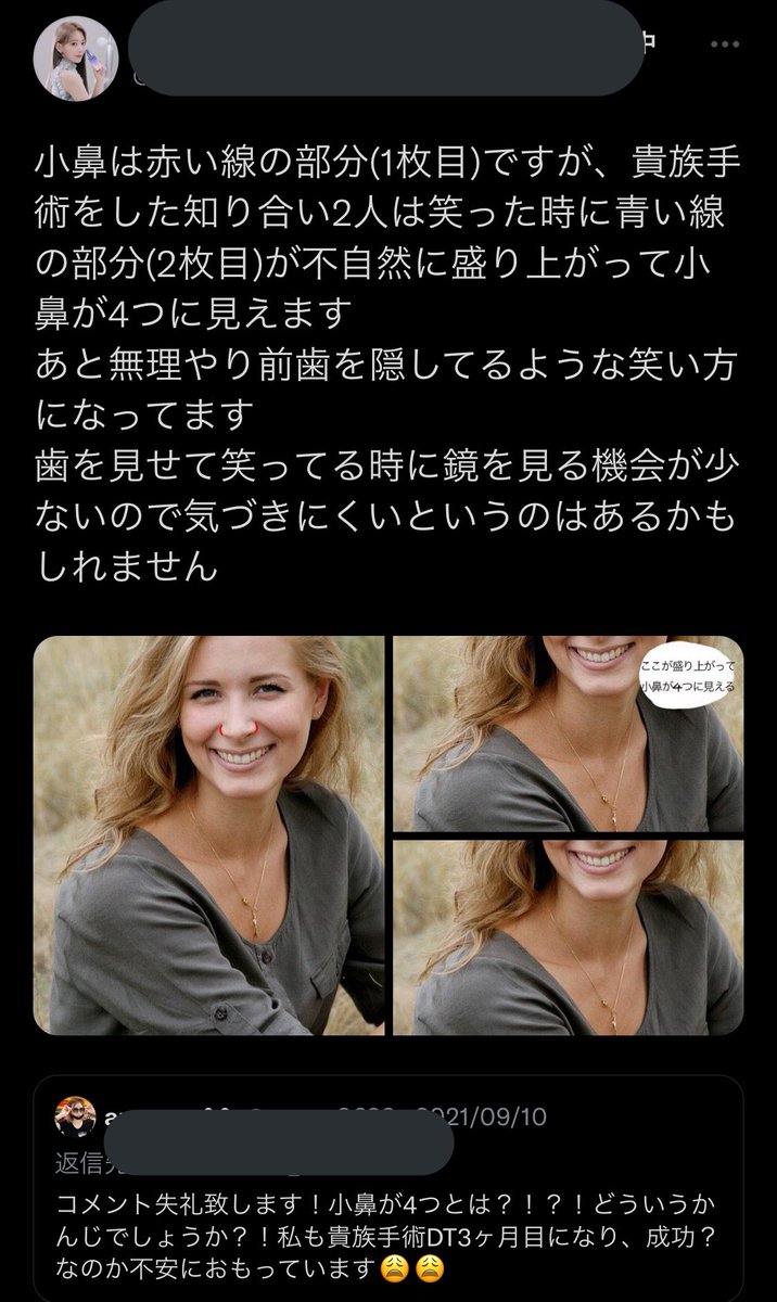 wmpmgtj's tweet photo. これ貴族手術あるあるで覚悟の上受けた貴族手術(耳介)DT18

・笑顔は綺麗になった
・小鼻は4つにみえない
・陥没感は随分消えた
・完全には消えてないけど私は許容範囲
・鼻は上がって広がったけどやや戻った

入れる位置、医師の腕、顔の脂肪量、素材によって変わる気がした！ https://t.co/4hviNiCSA1