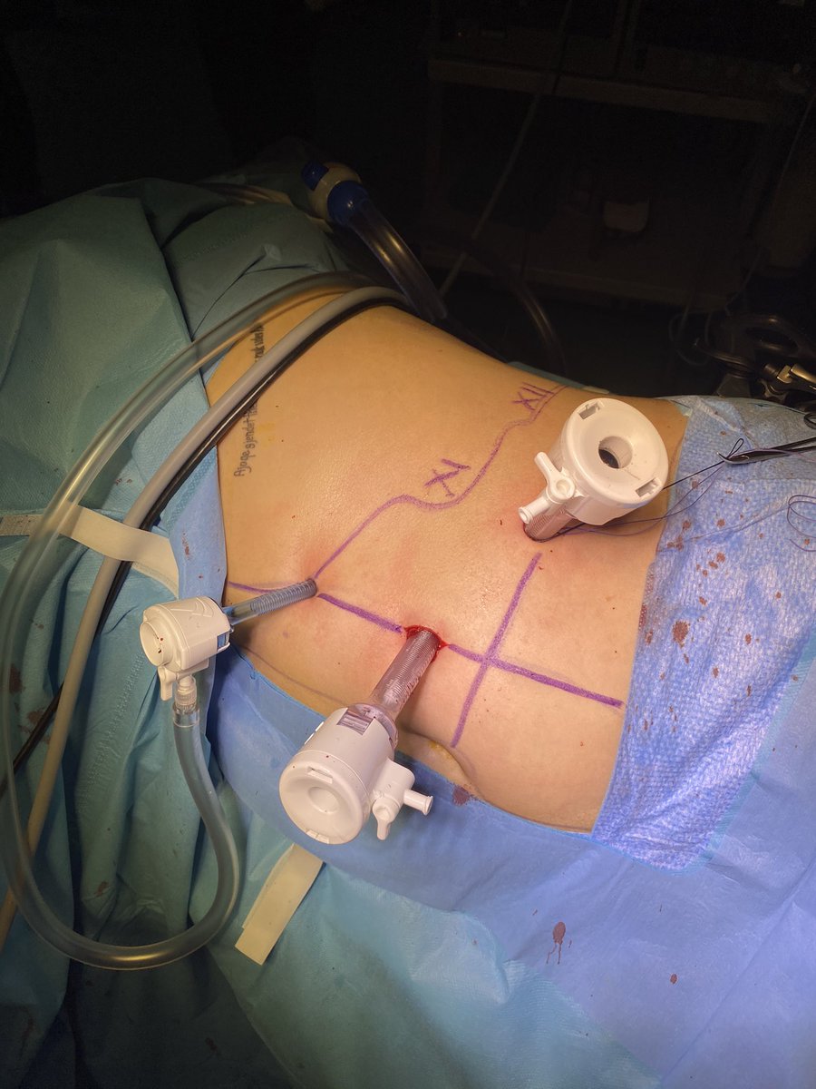 fgerminale's tweet photo. Conn’s syndrome: today a #laparoscopic partial #adrenalectomy at @BassanoUrology! @antoniocelia1 @tom_silvestri @LorenaDiMarco https://t.co/pBz67brMP9