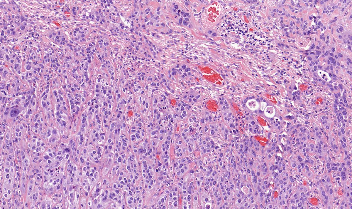 TristanRutland7's tweet photo. Colon, adult

#GIpath #pathtwitter #Pathresidents https://t.co/oBYjsrGie3