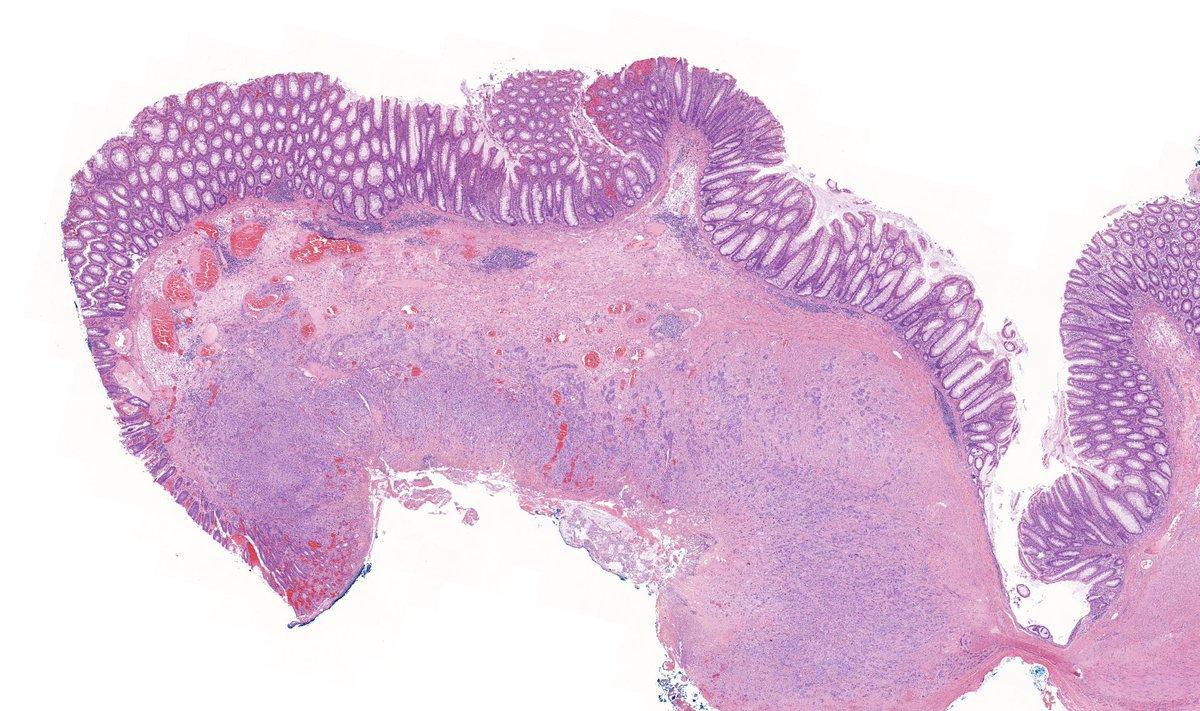 TristanRutland7's tweet photo. Colon, adult

#GIpath #pathtwitter #Pathresidents https://t.co/oBYjsrGie3