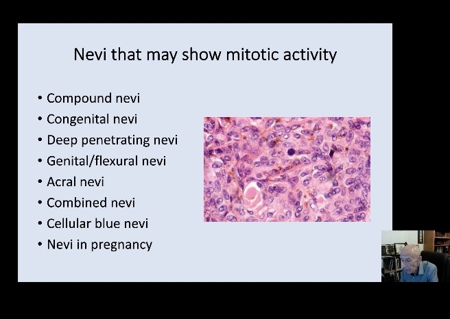 Very interesting dermatopath session by Prof McKee Sir #KAPCON2021 #KAPCON @VijayPatho @adi_agnihotri @suraksharaob @pembeoltulu @tumashankar @DrVasudevPrabhu @drsupriyatiwari @DrNithyashree @DrRamaswamyAS @Thejaspatho #dermatopath #skinpath @UshaKini @Sharadaraipath