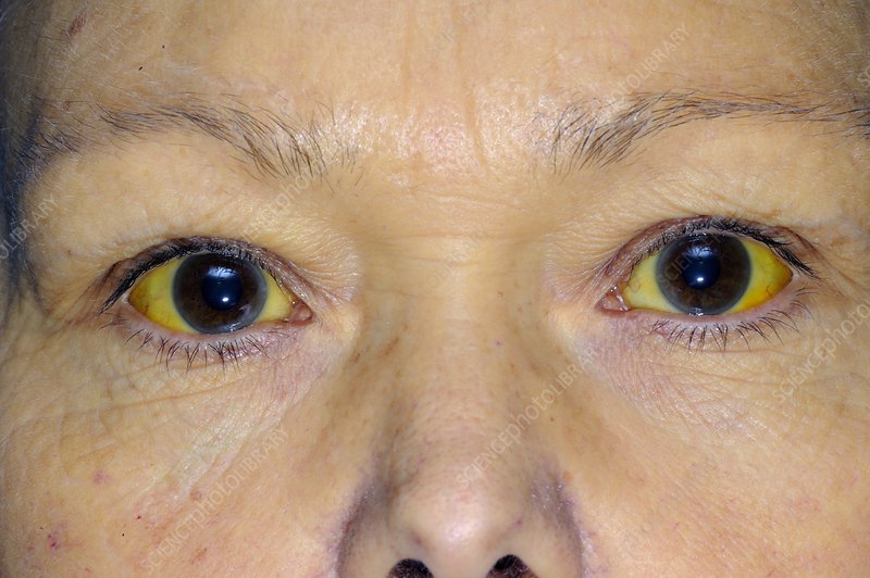 NwekeChideraEm2's tweet photo. jAUNDICE AND FEVER: Research has shown that "NAUCLEA DIDERRICHII" has a cure for Jaundice and also Fever. Cock the herb ( stem and back needed ) till its watercolor changes and accommodate in a glass, take the herbs twice daily for months. #jaundice #fever #herbs #medicinalherbs https://t.co/6xQUcaBjDG