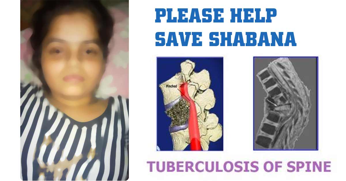 Make Shabana's spine surgery possible. Please contribute and share with your friends. 

charityalliance.in/crowdfund/camp…