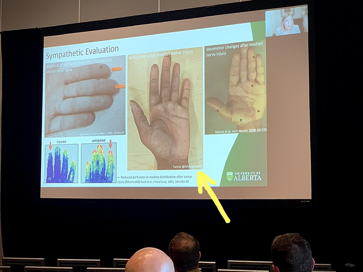 Can we update impact factor ratings now to take into account when one of your tweets gets quoted in an academic presentation? Wonderful virtually delivered talk right now on nerve injury by <a href="/HolliePowerMD/">Hollie Power</a> at #ASSH2021 panel hosted by <a href="/ChrisDyMD/">Christopher J. Dy MD MPH FACS</a> #NerveNerd <a href="/HandSociety/">ASSH</a>