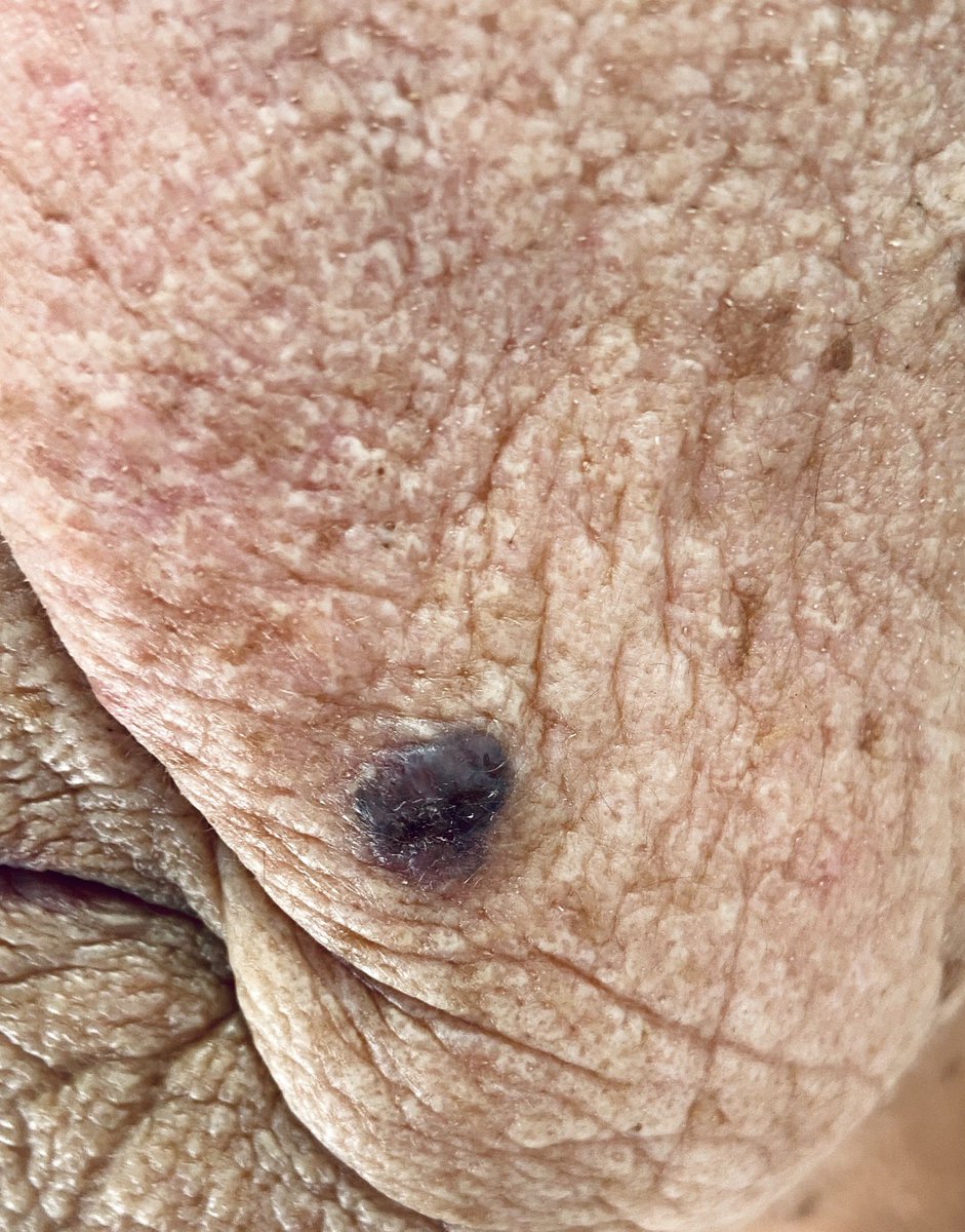AndamoyoAlberto's tweet photo. Mujer de 87 años, lesión de crecimiento lento en mejilla izquierda. “Le pica y le sangra” de ahí que quiera “quitárselo”.
 
Con la sospecha de lesión pigmentada atípica y entre las primeras opciones a considerar encontramos el carcinoma basocelular pigmentado o melanoma. https://t.co/n06AFSU3vy