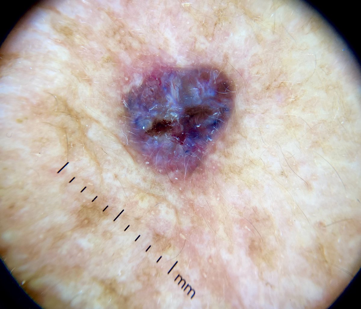 AndamoyoAlberto's tweet photo. 🔴Crecimiento lento 
🔴Brillo perlado
🔴Nidos ovoides, úlcera central, telangiectasias arboriformes, áreas blanquecinas, signo del 🌈 

Con el diagnóstico de #carcinoma basocelular pigmentado recordamos que frecuentemente aparece en las zonas del cuerpo expuestas al sol. https://t.co/SuDwQ8197j