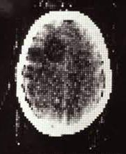 lumexaimaging's tweet photo. Did you know? 🧠 On this day in 1971, Sir Godfrey Hounsfield and Dr. Jamie Ambrose made history by performing the world's first clinical CT scan with a prototype device at the Atkinson Morley Hospital in Wimbledon, England.
#RadHistory #Radiology #RadiologyFact #FirstCTScan https://t.co/xpyUXhmadf