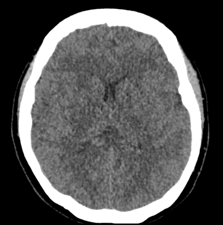 #AJNRcow >>Sept. 30, 2021 >> A 63-year-old woman was found unresponsive &amp; in respiratory arrest following attempted suicide by self-asphyxiation. MRI was performed 10 days into ICU admission due to abnormal cognition during weaning off sedation. View here ajnr.org/content/cow/09….