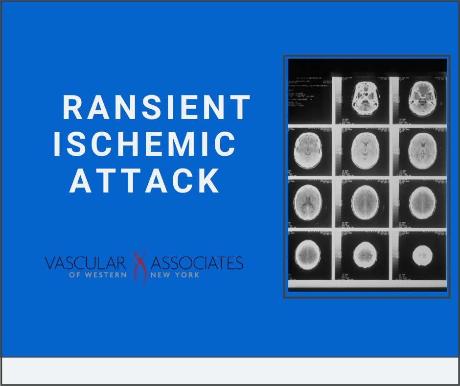 Everything you need to know about the causes, symptoms, and treatment of Transient Ischemic Attack.

bit.ly/2XCWGm6
#VascularHealth #CarotidArteryDisease #HealthTips