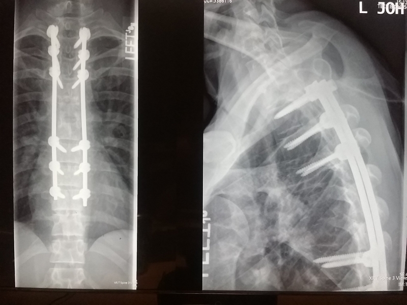 DBKynd's tweet photo. @Jbams01 Speaking of X-rays. Here's mine after my motorcycle accident. Wear a helmet kids. 😀 https://t.co/I1uueibZcu