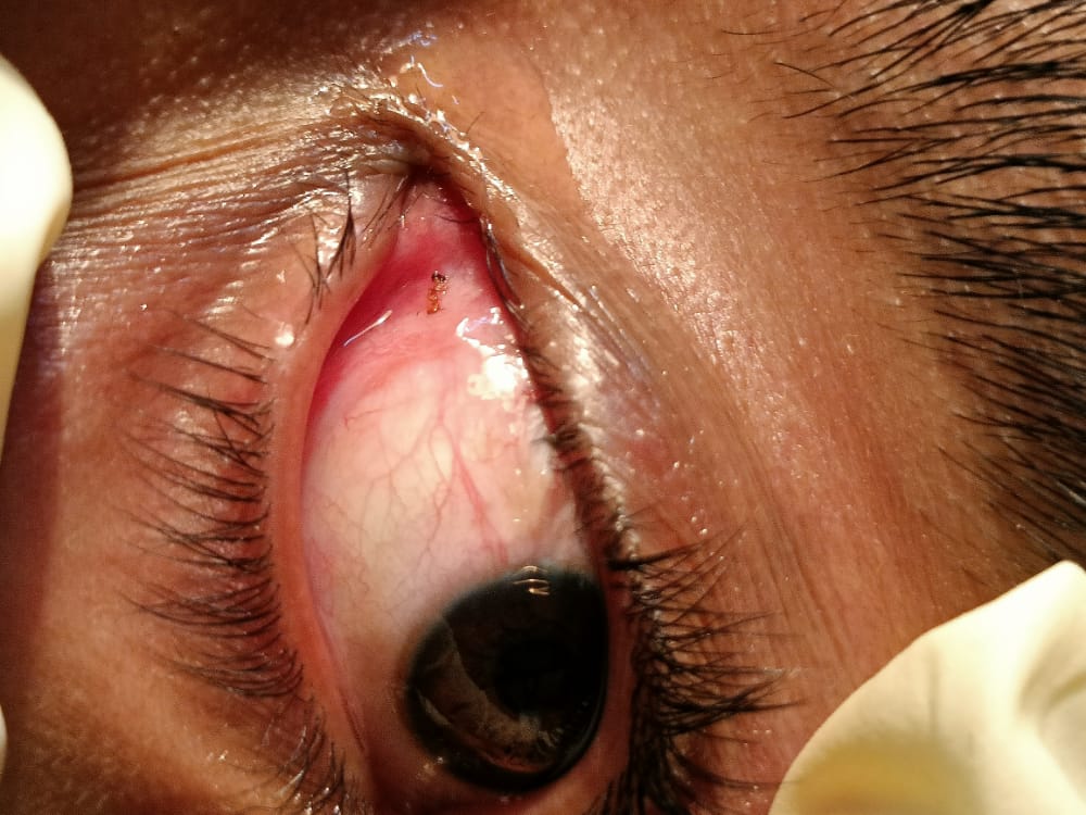 CRLingeswaran's tweet photo. Ant forgein body was removed  from  eye.Which was difficult  to remove from eye as it  was stuck into the conjunctiva deep but with grace of God  we removed it.Without any tissue  damage  to the eye.
DR.C.RAM.LINGESWARAN M.B.B.S,D.O.,
Eye specialist 
Dr.Nainar hospital 
Madurai https://t.co/WHhh3dQE5k