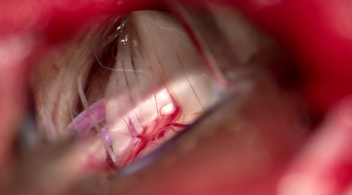 Excellent example of the neurovascular conflict which can be seen in #trigeminalneuralgia.  Right sided #MVD performed <a href="/InovaHealth/">Inova</a> with 100% resolution of symptoms post-op. <a href="/painsection/">AANS/CNS Joint Section on Pain</a> <a href="/AANSNeuro/">AANS</a> <a href="/AANSNeurosurg/">AANS Neurosurgeon</a> <a href="/TNAwareness/">Trigeminal Neuralgia Awareness⚡</a> <a href="/EndTN/">EndTrigeminalNeuralgia</a>