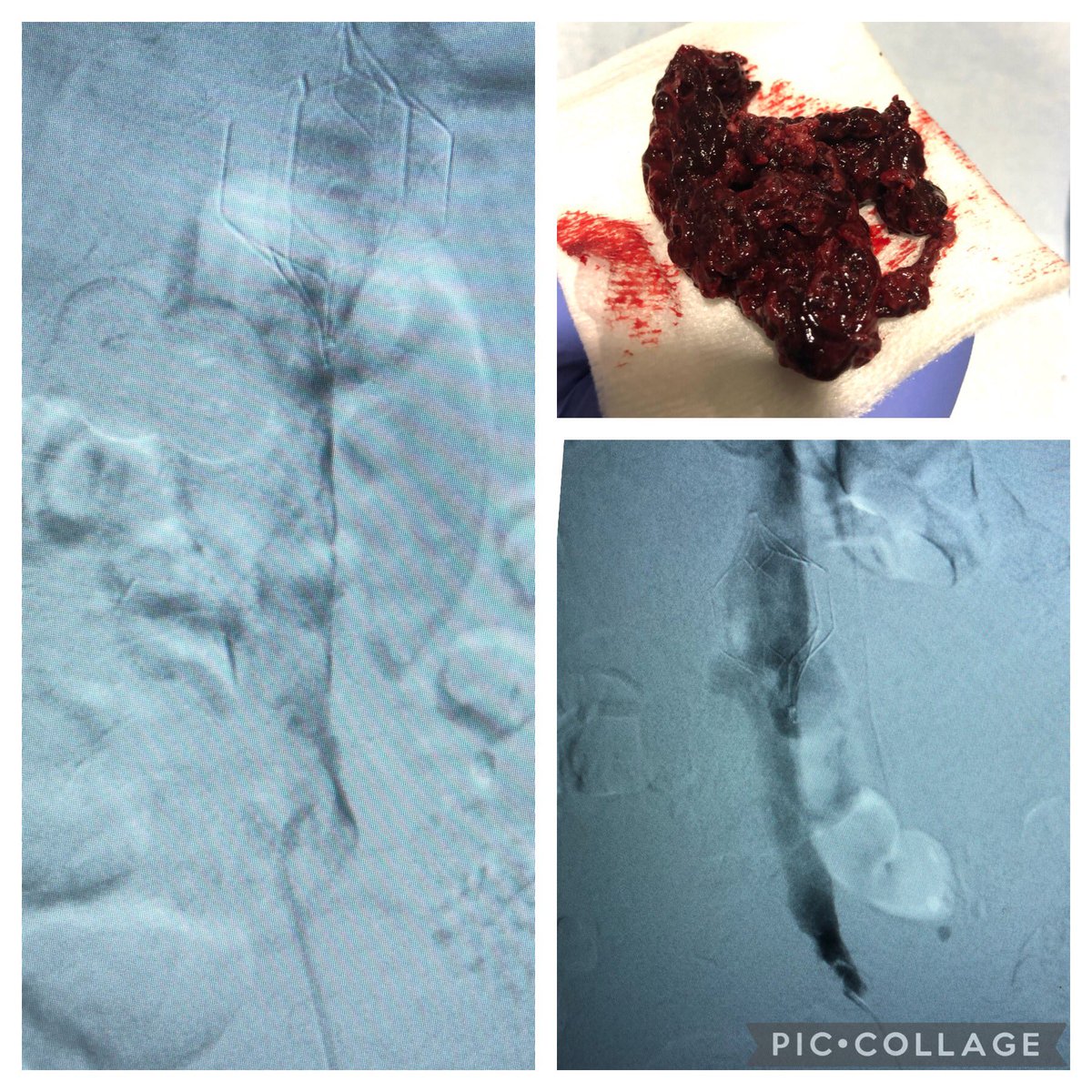 JeradStutes's tweet photo. What would you do? Thrombosed IVC and IVC filter.   Cleared in under 8 minutes with 10Fr QuickClear! #PhilipsQuickClear https://t.co/qbejb9kzMb