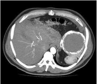 10bladeae's tweet photo. A new #FIOF is up! This 56 y/o male presented with few months history of pain in the left side of back and discomfort in the left hypochondrium. CT abd+ C was done. Head over to https://t.co/sCaHvyImlp and #figureitout! #10blade 
#SoMe4Surgery #SurgicalResident #generalsurgery https://t.co/ajbvf7pWO1