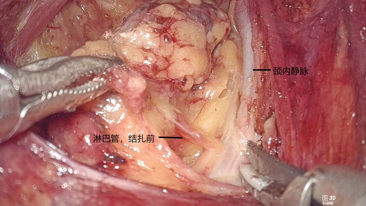 These are the endoscopic cervical lymph node dissections that I recently completed.