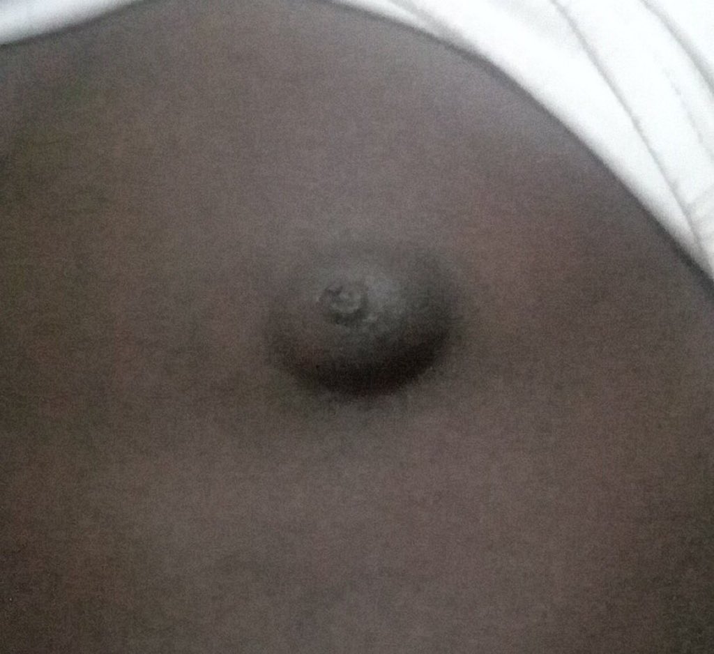JeffreyGuterman's tweet photo. 🔺 @Danitovadivadi, a very kind follower, said his friend, a 25-year-old man, has experienced enlargement of his nipples. I suggested this man see a physician ASAP. Any other informed suggestions? Jokers will be booted. https://t.co/JUEAgnLRN6