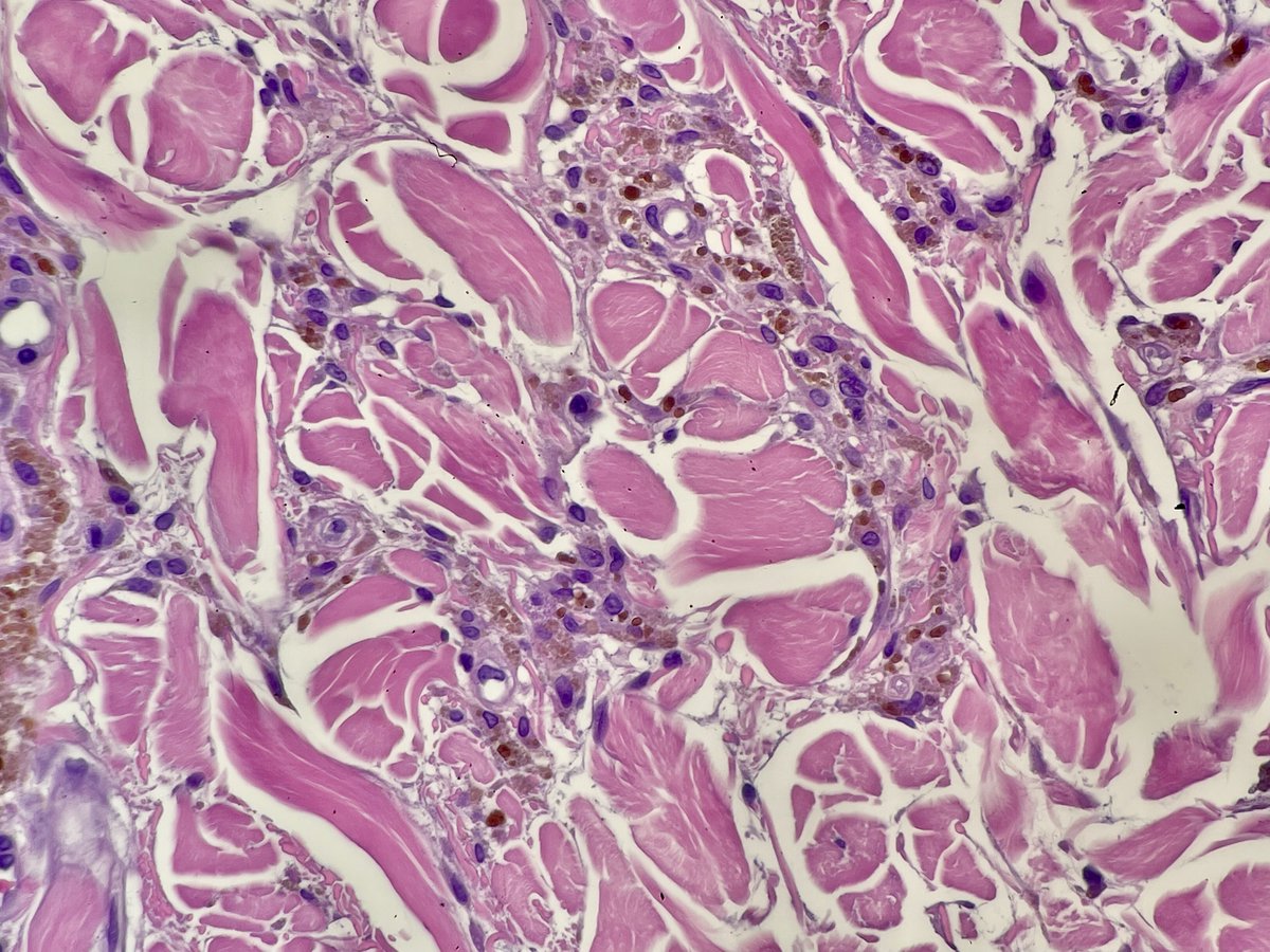 elimoreymd's tweet photo. Skin biopsy from distal thigh, 60-70 year old male. What is your best diagnosis? How do you know? #pathtwitter #dermpath #dermtwitter #MedEd #dermatology https://t.co/EX5JD3eY5K