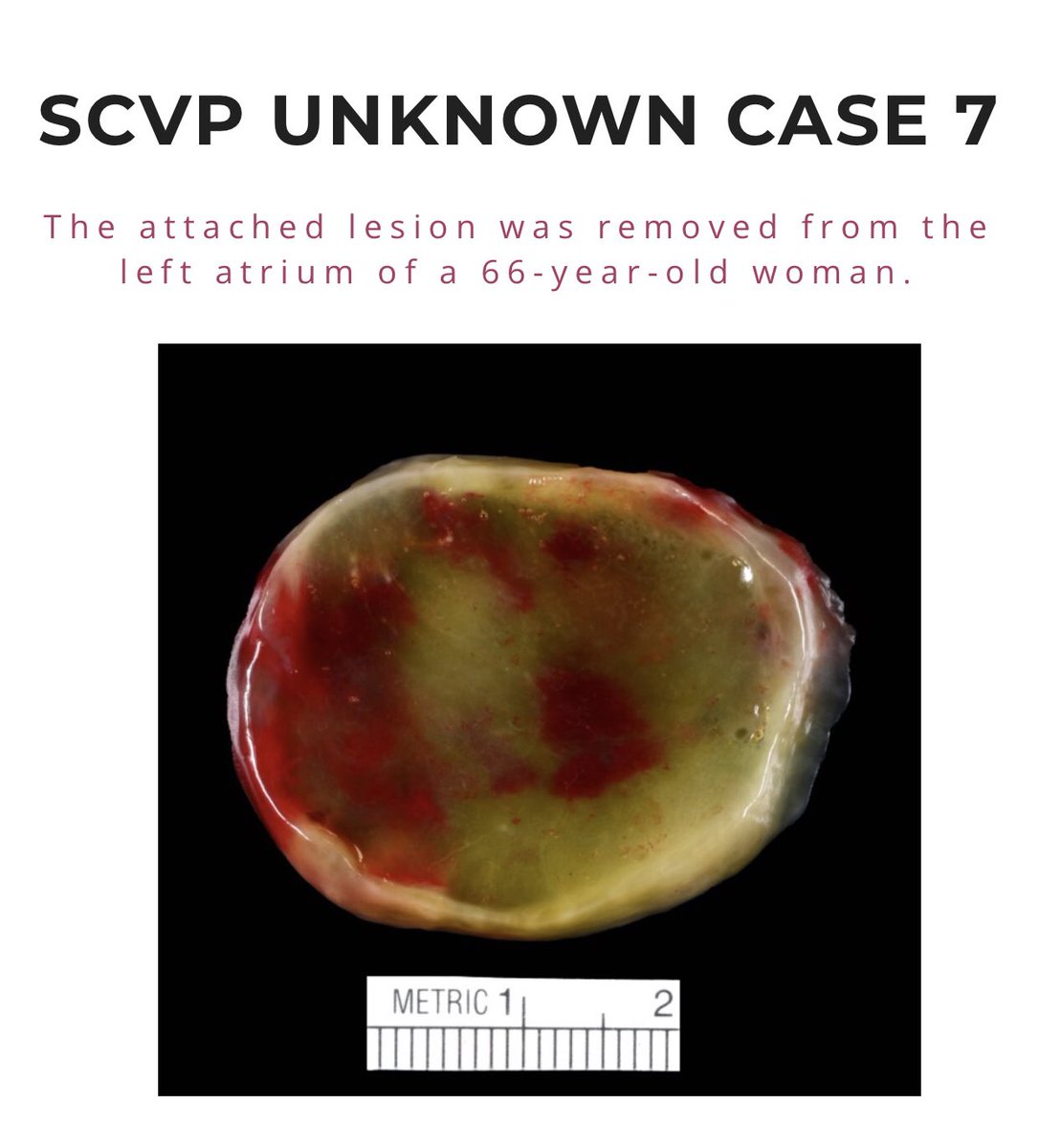 The SCVP Unknown Case 7 is now posted! 

View the question and read more at the link below.

#cvpath #cardiacpath

scvp.net/com/bois_quiz_…