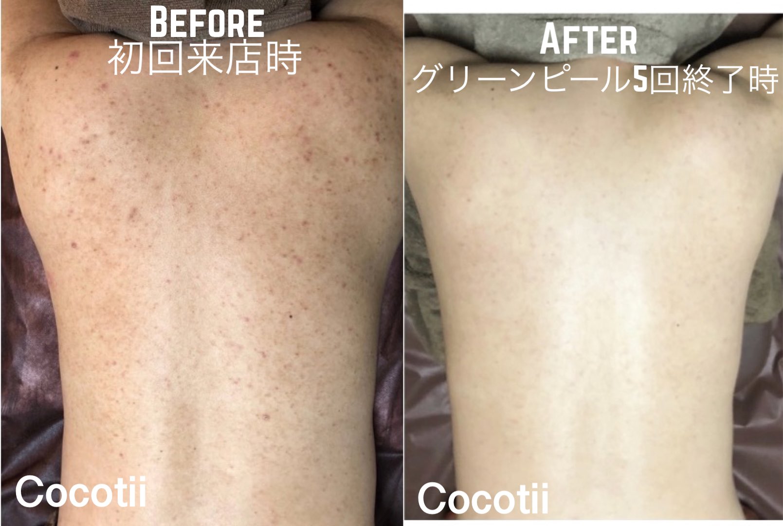 Twitter 上的 Cocotii グリーンピール専門店 背中ニキビ お尻 二の腕 顔 脚 毛孔性苔癬 Cocotii 男性の背中ニキビ 肩 胸 マラセチア ニキビ跡にグリーンピール 背中全面 5回施術 ビフォーアフター症状例 詳細 ホットペッパー初回クーポンあり T Co