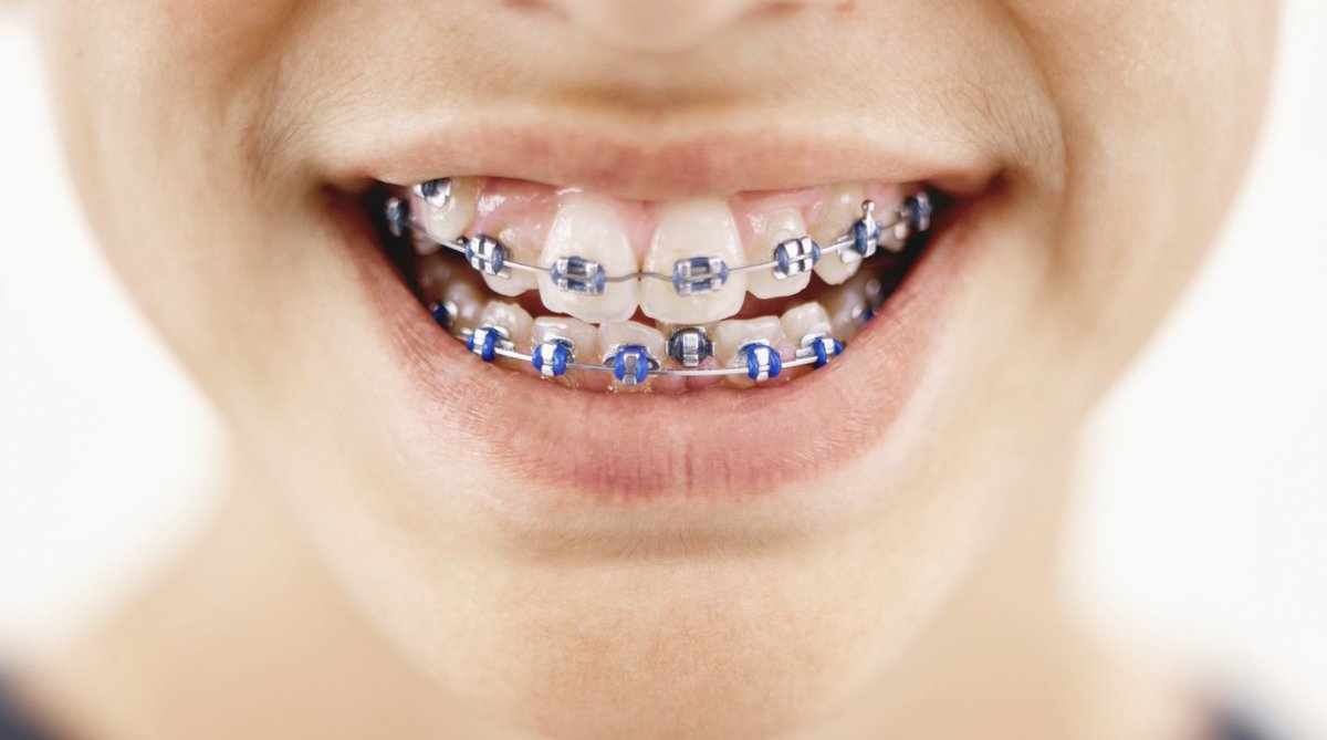 красивые брекеты. Mtx брекеты. брекет система. брекеты ормко. поставить брекеты в уфе.