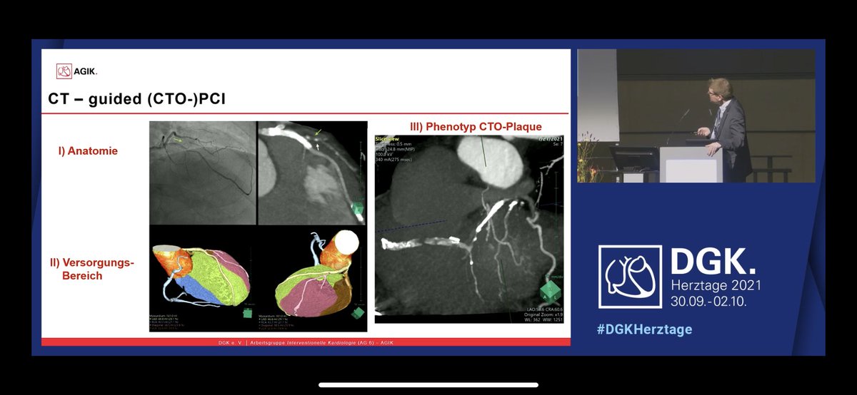 kaschenke's tweet photo. @m_leistner on the use of #presicionPCI and the use of CardiacCT in planing and handling of calcified lesions / CTO #pcicase #DGKHerztage @HolgerNef @AGIKinterv @KambisMashayek1 @KardiologieHH @thiele_holger @klinki_hh https://t.co/Wz8vvToVzH