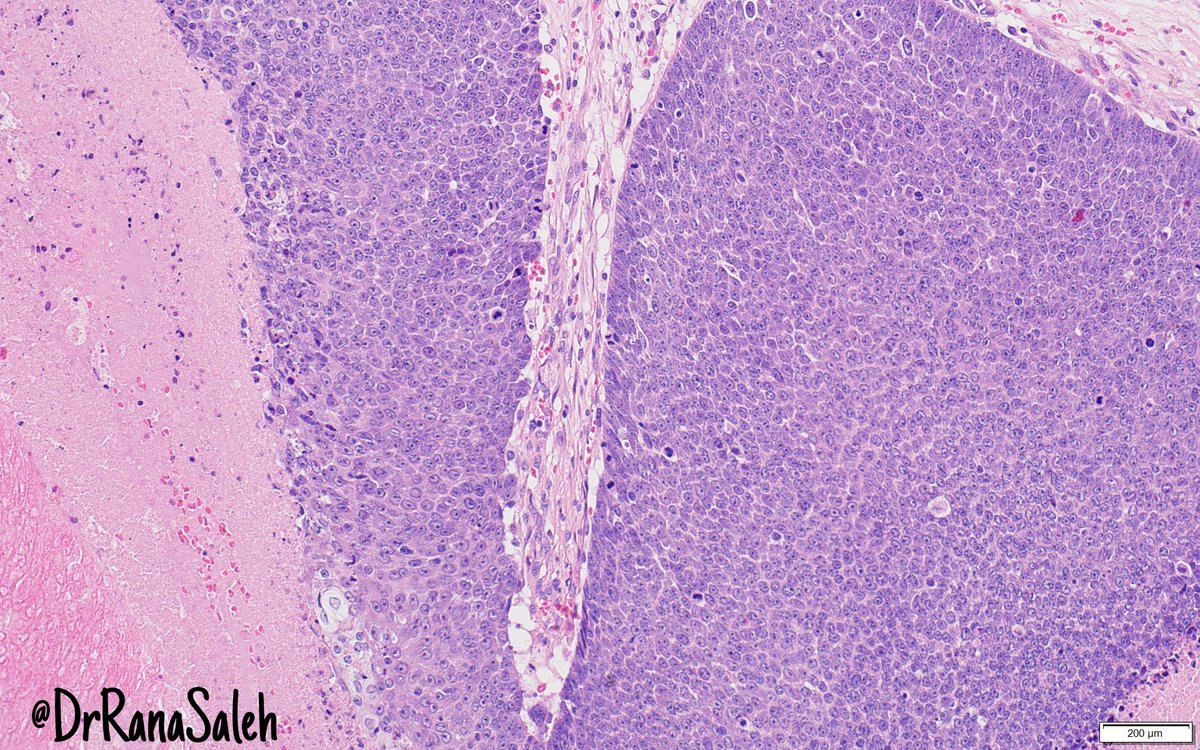 DrRanasaleh's tweet photo. I love this tumor #pathclassic #pathresidents #dermpath https://t.co/iHLSg4PXRz