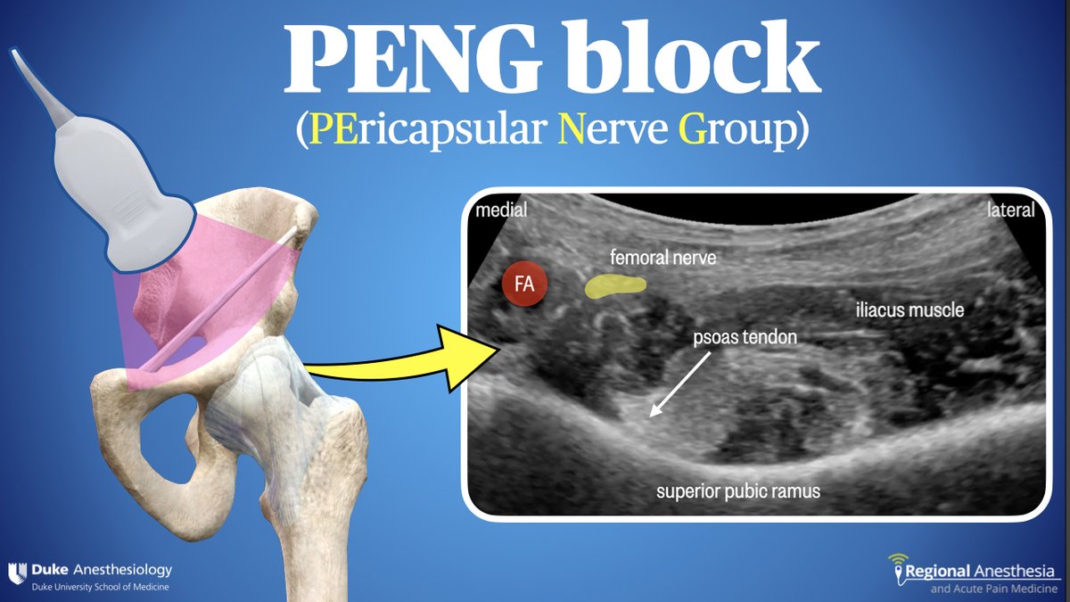 On Day 2 of #blocktober, we'll be taking a deep dive on the PENG (Pericapsular Nerve Group) block. This technique has very effective for hip fracture pain as well as pain following THA or arthroscopy. It's also an easy block to teach and learn. How are you using PENG? #DukeRAP