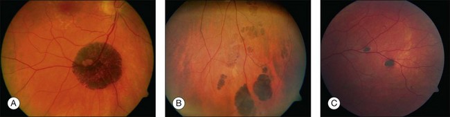 AlaaRoto67's tweet photo. C Is atypical CHRPE .
A is solitary CHRPE.
B is multifocal CHRPE .
#CHRPE https://t.co/iVkJbZs8UB