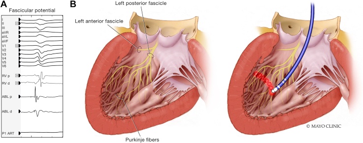 pubmed.ncbi.nlm.nih.gov/34317571/

A novel ablation technique in idiopathic ventricular fibrillation!!!