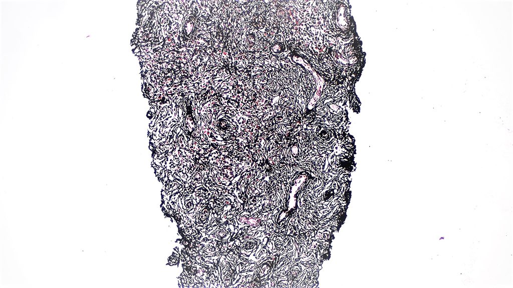 NephroPath's tweet photo. IgG4 related TIN.  Dense lymphoplasmacytic infiltrate with swirling fibrosis and bird's eye pattern fibrosis in this case. Rich eosinophil infiltrate is also common finding… Have you ever seen more attended eosinophil convention? https://t.co/qLZKnFszzF