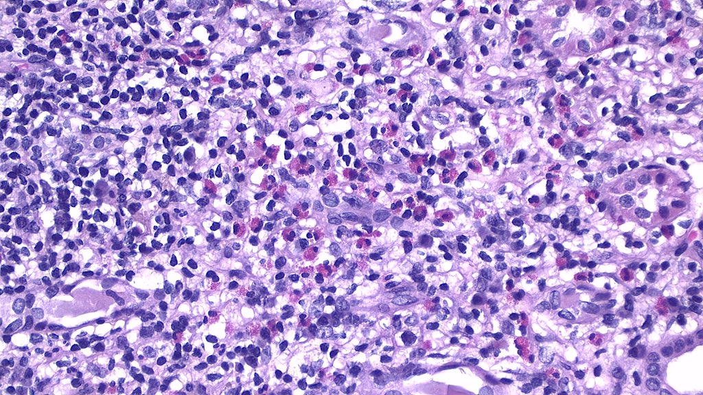 NephroPath's tweet photo. IgG4 related TIN.  Dense lymphoplasmacytic infiltrate with swirling fibrosis and bird's eye pattern fibrosis in this case. Rich eosinophil infiltrate is also common finding… Have you ever seen more attended eosinophil convention? https://t.co/qLZKnFszzF