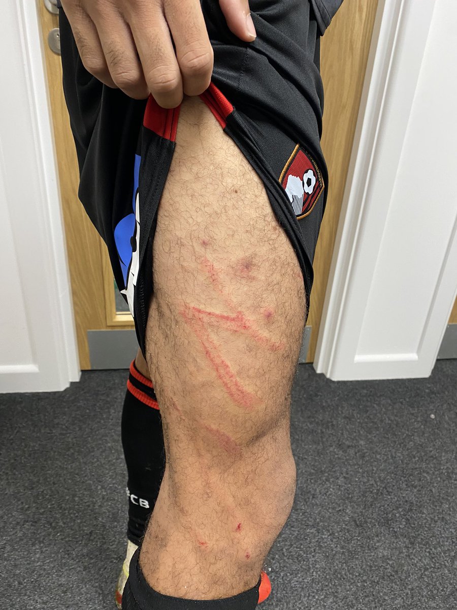 kristemple's tweet photo. 🍒 The thigh of #AFCB striker Dom Solanke, after the challenge from #SUFC defender Enda Stevens that led to the award of the match-turning penalty. No card was issued 👀 https://t.co/m8t4miNlcv