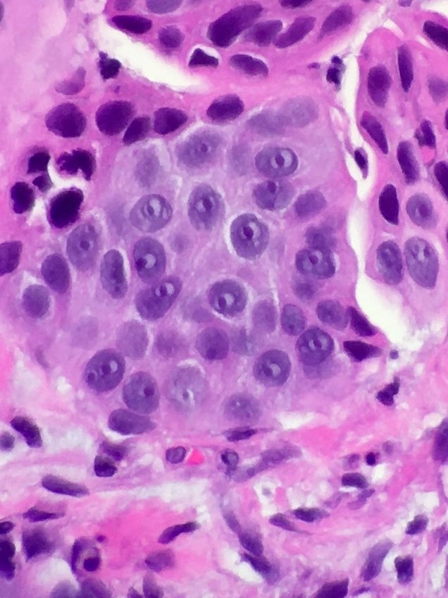 megothelioma's tweet photo. Found these peepers in a breast cancerπππ#PathTwitter #MSGPath https://t.co/Tlb9DykP0J