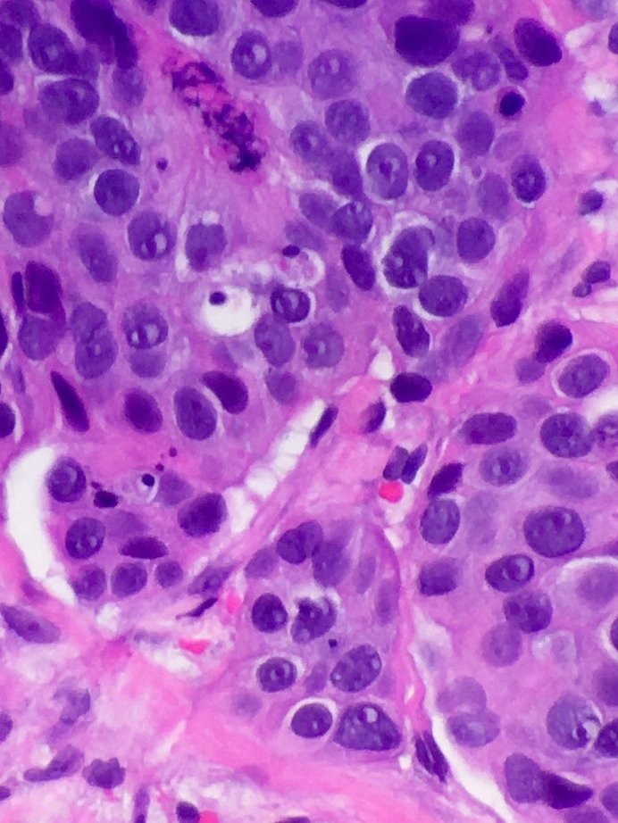 megothelioma's tweet photo. Found these peepers in a breast cancerπππ#PathTwitter #MSGPath https://t.co/Tlb9DykP0J