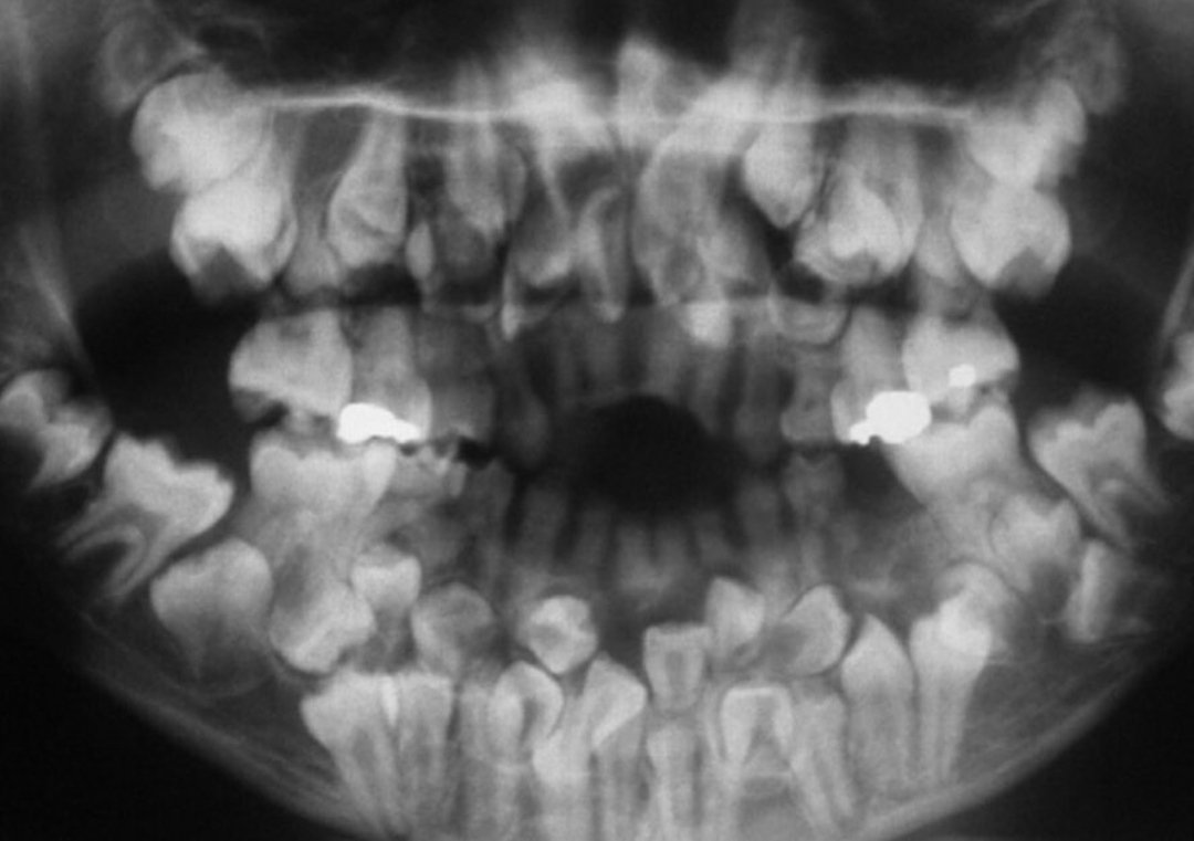RobeValdivia's tweet photo. 81 Dientes: 18 Temporales, 32 Permanentes y 31 Supernumerarios 😱 https://t.co/tQSTD3x8D3