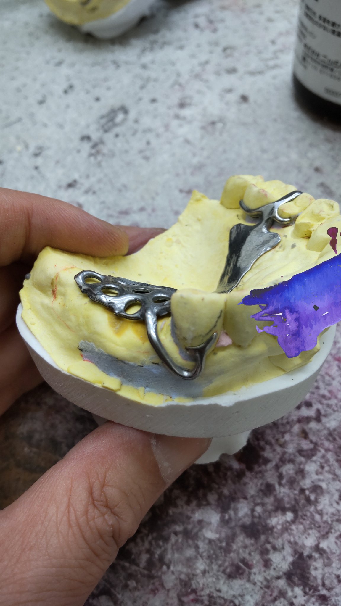 J☆Dental Laboratory on Twitter "【保険の義歯を見直そう】 バークラスプを積極的に使う https//t.co/ev66GfOSoM" / Twitter