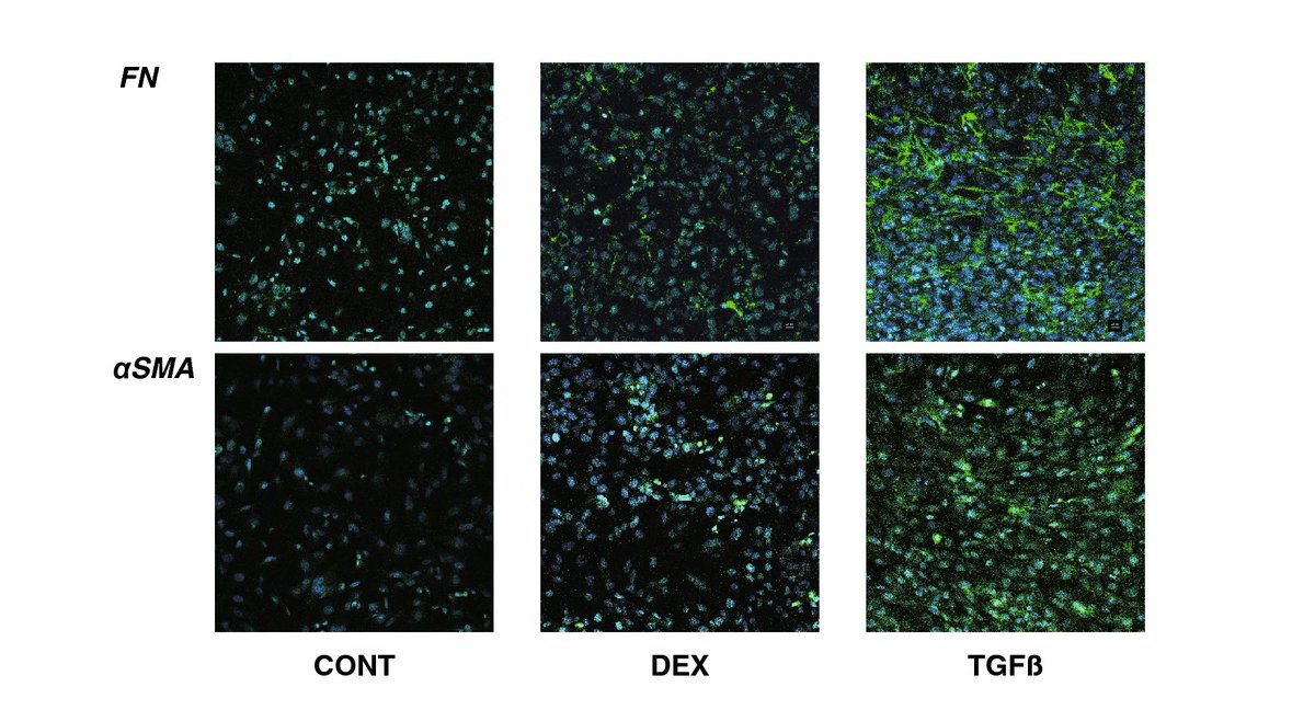 ExtracellMatrix's tweet photo. The establishment of viable #glaucoma models using dexamethasone or TGFβ2 treated 3D cultured human trabecular #meshwork cells was performed by Sapporo Medical University scientists. Full article below: ⬇️

@SciReports | https://t.co/CVJLdXwKVf https://t.co/zvlIRvOPJq