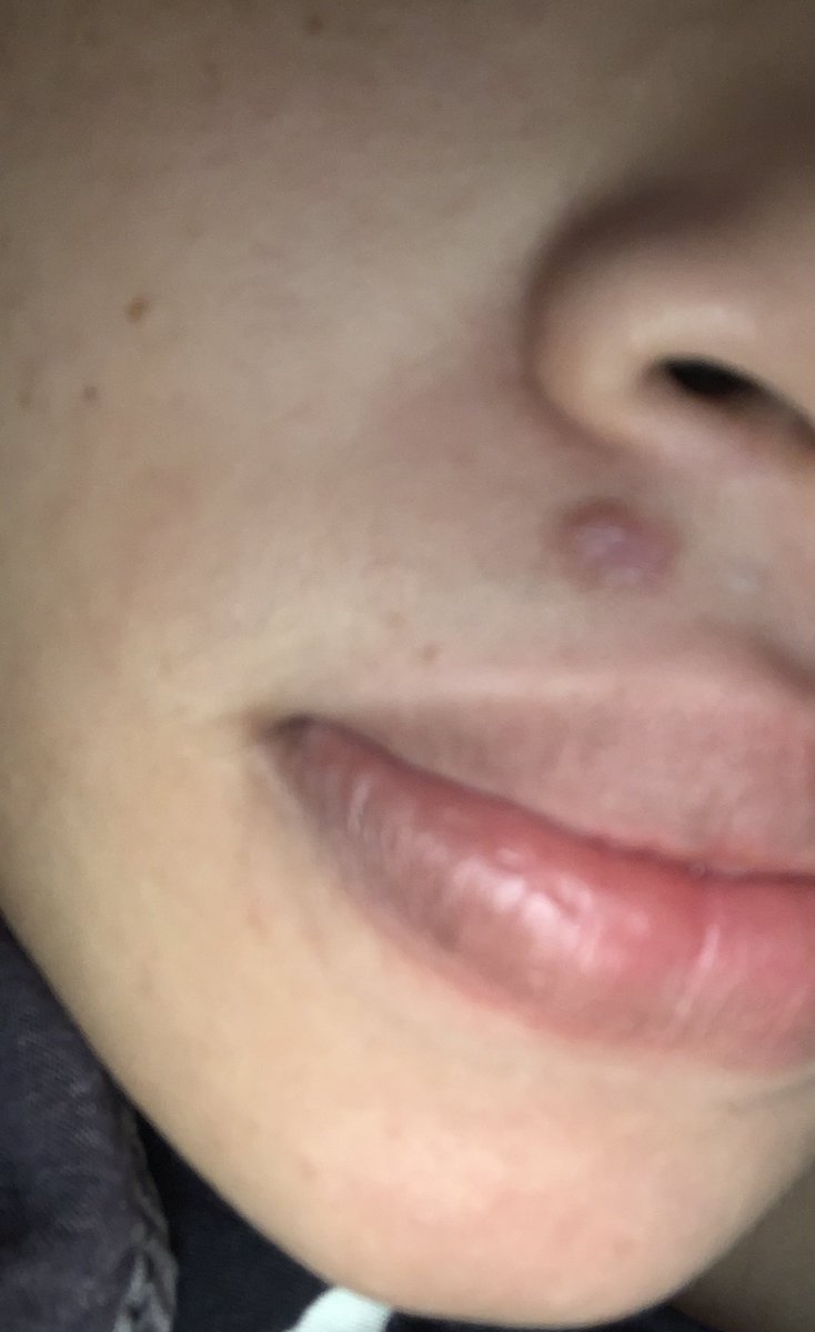sarxhah's tweet photo. @dianahsmd i nak tanya kalau parut mcm ni mcm mana nk hilang ye ? ni keloid ke ? parut ni baru dalam 2weeks mcm tu lepas luka.  kulit i mcm sensitif sb kalau luka je mmg akan ada parut timbul 🥺 dekat paha dgn tangan mmg timbul https://t.co/MgONvqIYLL