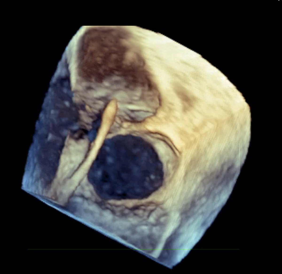 ralogon's tweet photo. Successful closure of a large baffle dehiscence - challenging case with @erichorlick. Good fitness test for me! 😂 @TorontoACHD @PMunkCardiacCtr https://t.co/mnmD83u9U1
