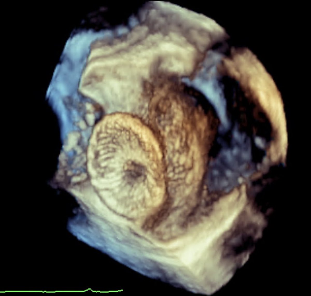 ralogon's tweet photo. Successful closure of a large baffle dehiscence - challenging case with @erichorlick. Good fitness test for me! 😂 @TorontoACHD @PMunkCardiacCtr https://t.co/mnmD83u9U1