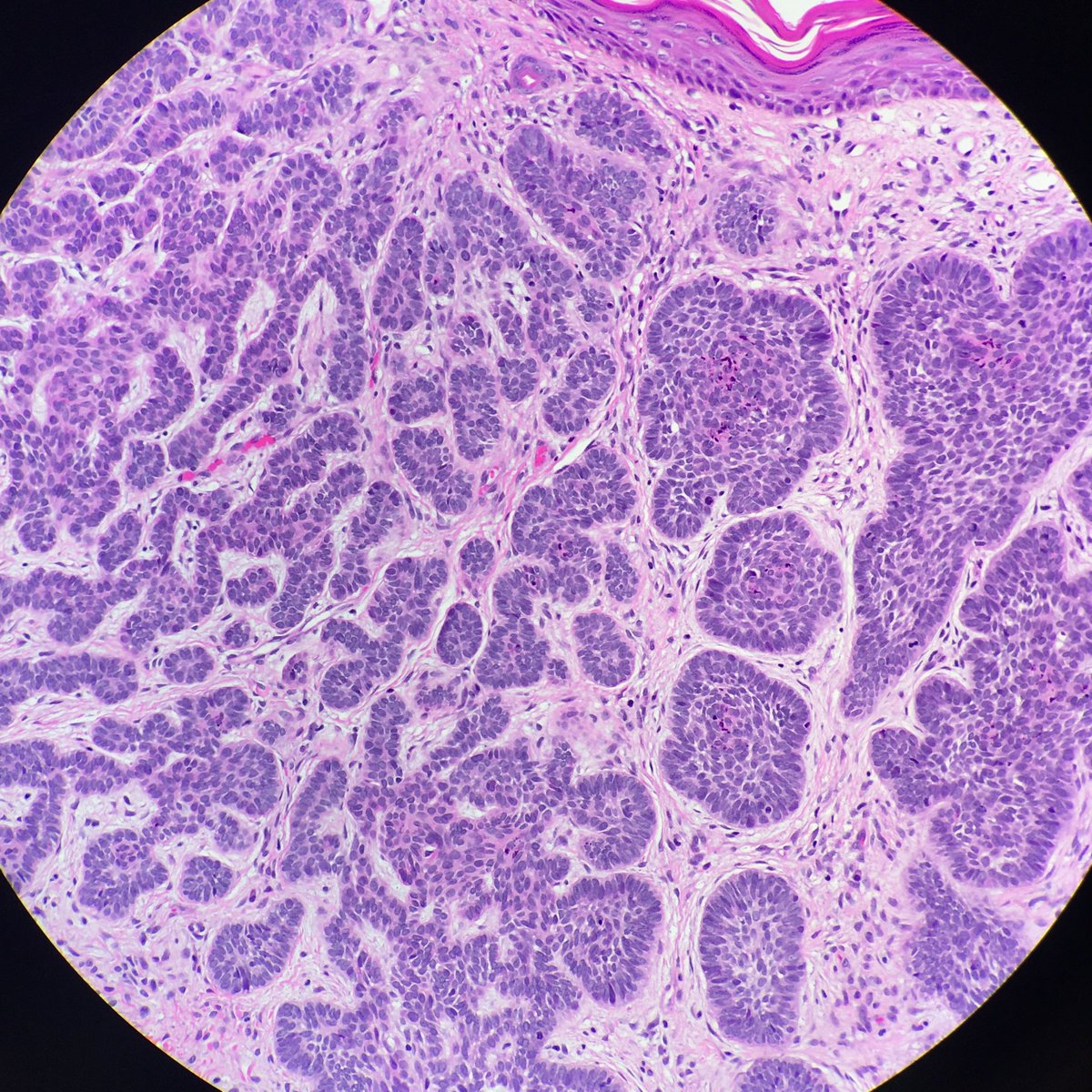 megothelioma's tweet photo. Just an aesthetically pleasing BCC βΊοΈ#PathTwitter #dermpath #MSGPath https://t.co/6hRQtR3Ii2